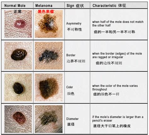 痣是凸的|身上7种痣一定会癌变！